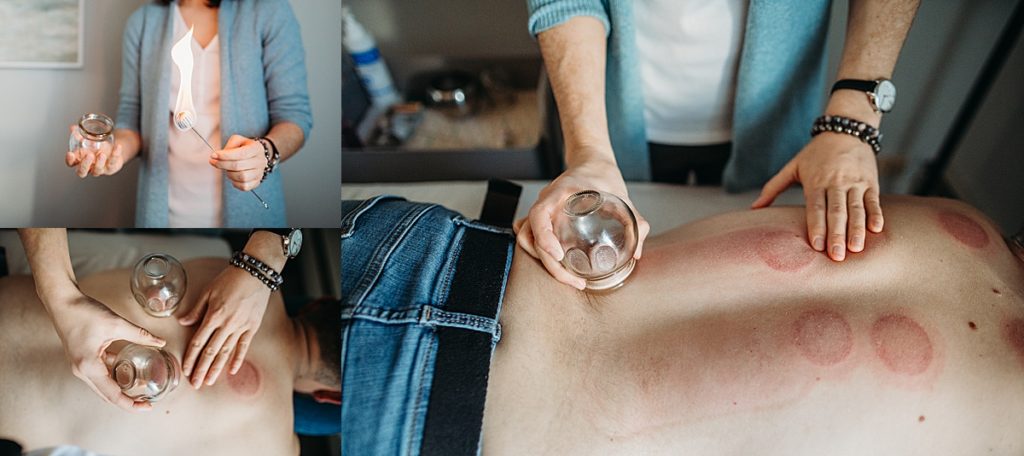 images of cupping practice in boston